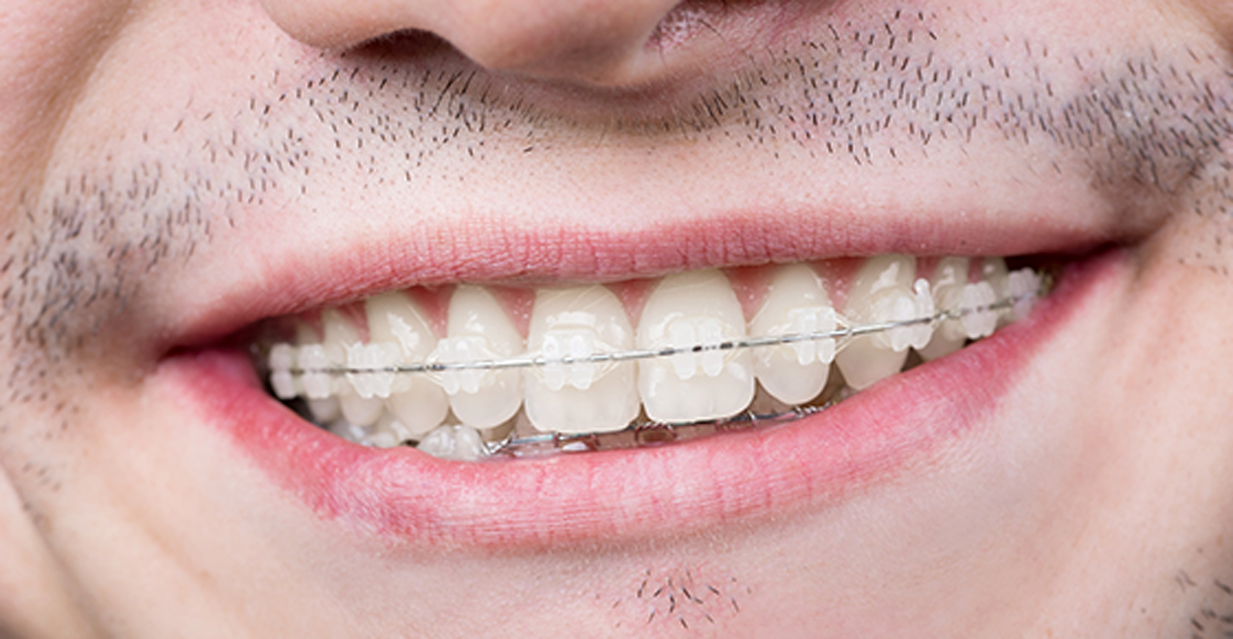 Instalación de Brackets Cerámicos Dentalclinic